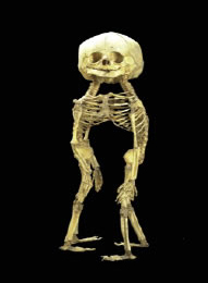 Mutter Museum single head two bodies